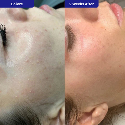 Kiyss Milia Remover Serum