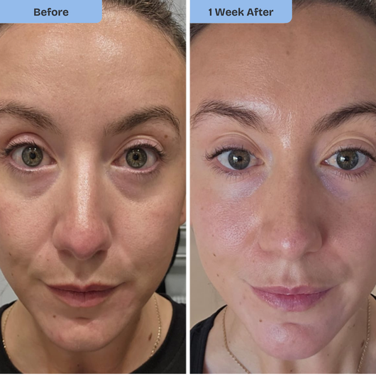 Kiyss Micro Needling Infusion Patches