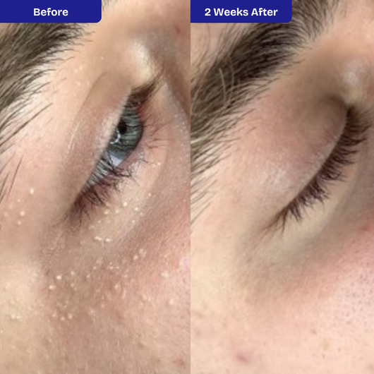 Kiyss Milia Remover Serum