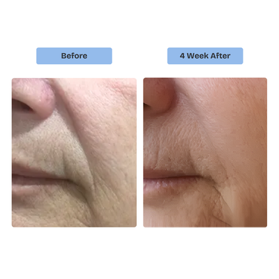 Kiyss Micro Needling Infusion Patches