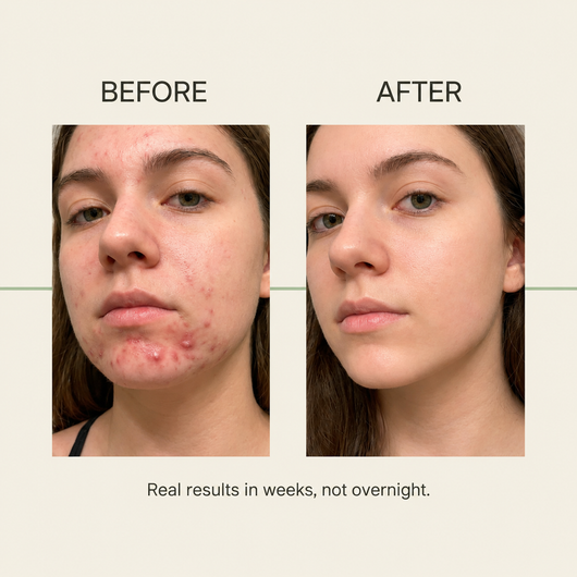 Kiyss Gut-Skin Probiotic For Teen Acne