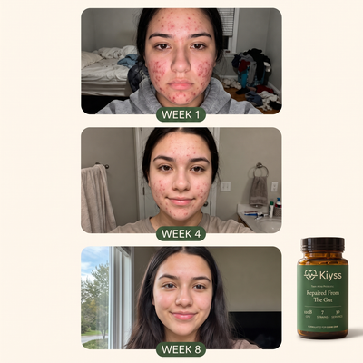 Kiyss Gut-Skin Probiotic For Teen Acne