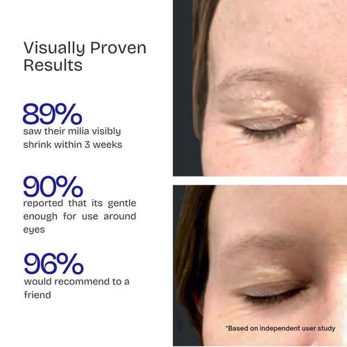 Kiyss Milia Remover Serum